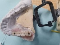 Результат тимчасового зубного мосту в SoftDentalCare Clinic, відновлення на моделі
