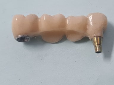 Результат тимчасового зубного мосту в SoftDentalCare Clinic, природне відновлення зубів