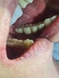 Результат тимчасового зубного мосту в SoftDentalCare Clinic, покращення вигляду і функції