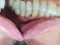 Результат тимчасового зубного мосту в SoftDentalCare Clinic, покращення посмішки та функції