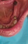 Результат встановлення тимчасового зубного мосту в SoftDentalCare Clinic, видно імпланти