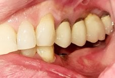 Результат тимчасового зубного мосту в SoftDentalCare Clinic, покращення функції та естетики