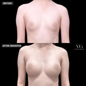 До и после увеличения груди в VG Plastic Surgery, видимый результат через 3 месяца