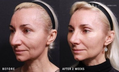 Результаты до и после подтяжки лица в VG Plastic Surgery, омоложение через 2 недели