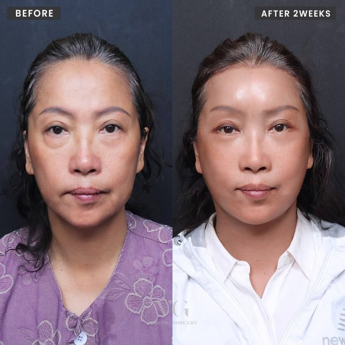 Resultados de lifting endoscópico facial antes y después en VG Plastic Surgery, rejuvenecimiento