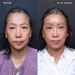 Efekty liftingu endoskopowego twarzy przed i po w VG Plastic Surgery, odmłodzenie