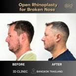 Efekty przed i po otwartej korekcji nosa złamanego w ID Clinic Bangkok