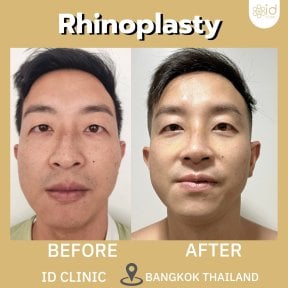Efekty przed i po rhinoplastyce w ID Clinic Bangkok, naturalne wymodelowanie nosa
