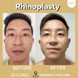 Efekty przed i po rhinoplastyce w ID Clinic Bangkok, naturalne wymodelowanie nosa