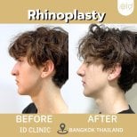 Efekty przed i po rhinoplastyce w ID Clinic Bangkok, poprawiony profil nosa widoczny
