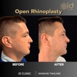 Efekty przed i po otwartej plastyce nosa w ID Clinic Bangkok, poprawiony profil nosa