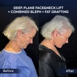 Before and after deep plane facelift and neck lift results at Dr. Safa Manav Clinic