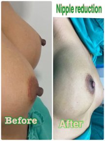 before-after photo nipple-reduction