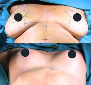 before-after photo top-surgery