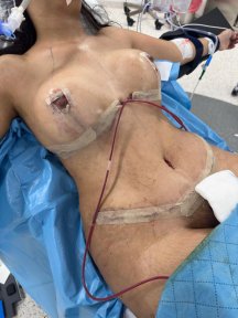 before-after photo top-surgery