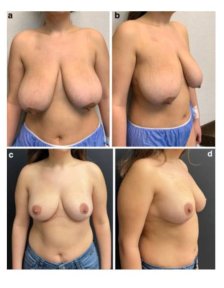 before-after photo top-surgery