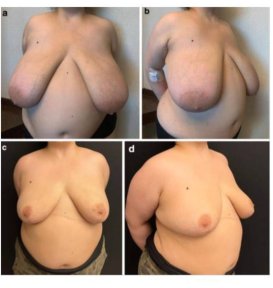 before-after photo top-surgery