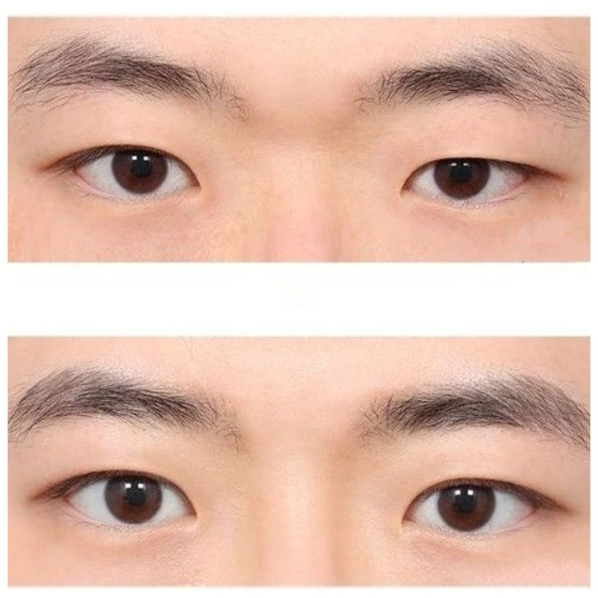 نتائج عملية شد الجفن العلوي في AB Plastic Surgery – تحسين شكل الجفن العلوي
