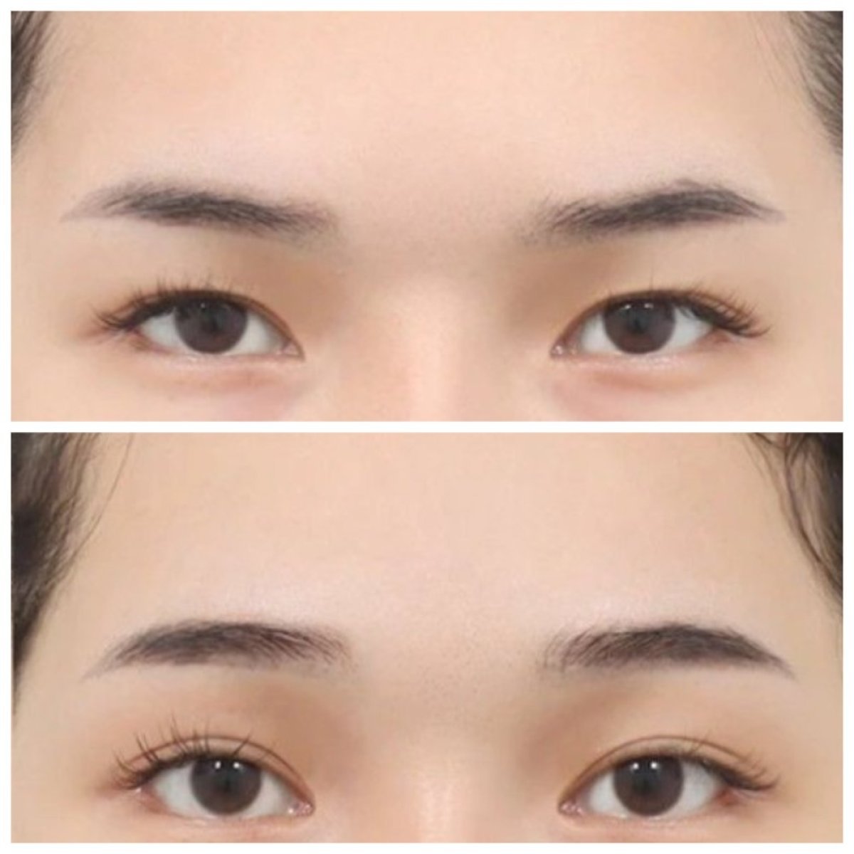 Resultados de blefaroplastia superior antes y después en AB Plastic Surgery – mirada renovada