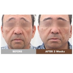 before-after photo podtazka-kozi-lica-fejslift
