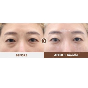before-after photo blefaroplastika-korrekciya-vek