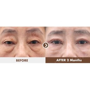 before-after photo blefaroplastika-korrekciya-vek