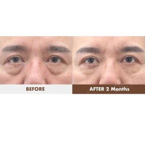 before-after photo blefaroplastika-korrekciya-vek