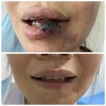 Resultados antes y después de embolización de MAV en labios, mejoría visible