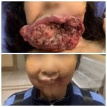 Resultados antes y después de cirugía de tumor facial – mejora significativa en la zona inferior