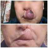 Resultados antes y después de embolización AVM: mejora en el aspecto del labio