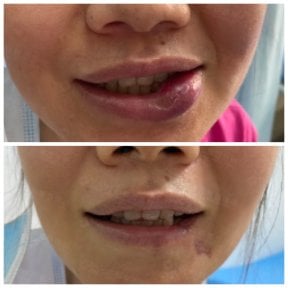 Resultados antes y después de embolización de MAV: reducción de hinchazón labial y mejora estética