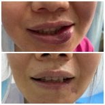 Resultados antes y después de embolización de MAV: reducción de hinchazón labial y mejora estética