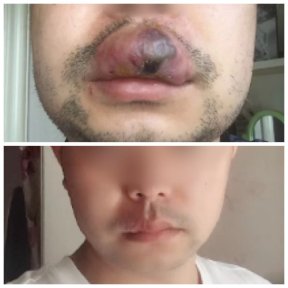 Resultados antes y después de embolización AVM: mejora en labios y reducción de hinchazón