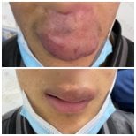 Resultados antes y después de embolización AVM: reducción de hinchazón labial y mejor aspecto