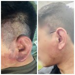 Resultados antes y después de embolización AVM, tratamiento de malformación vascular en oreja y mejilla
