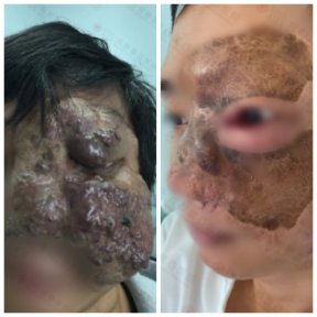 Resultados antes y después de embolización AVM en tratamiento de malformación vascular facial