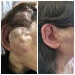 Resultados antes y después de embolización de MAV, menor hinchazón y mejor contorno auricular