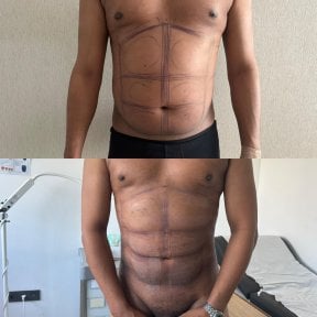 before-after photo hair-transplant