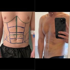 before-after photo hair-transplant