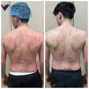 before-after photo lechenie-stvolovumi-kletkami