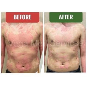before-after photo lechenie-stvolovumi-kletkami