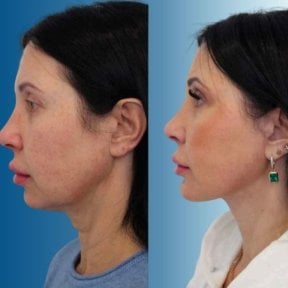 before-after photo tightening-of-facial-skin-facelift