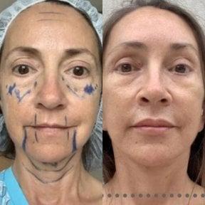 before-after photo tightening-of-facial-skin-facelift