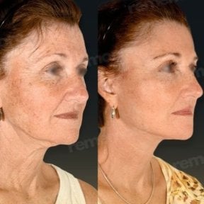 before-after photo face-contouring
