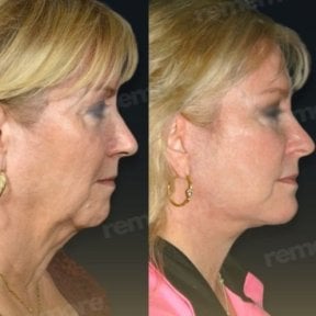 before-after photo face-contouring