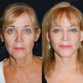 before-after photo face-contouring