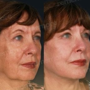 before-after photo face-contouring