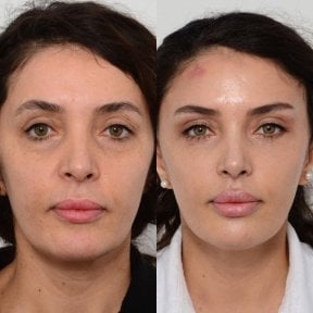 before-after photo face-contouring