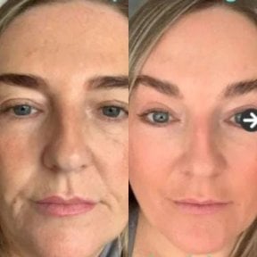 before-after photo face-contouring