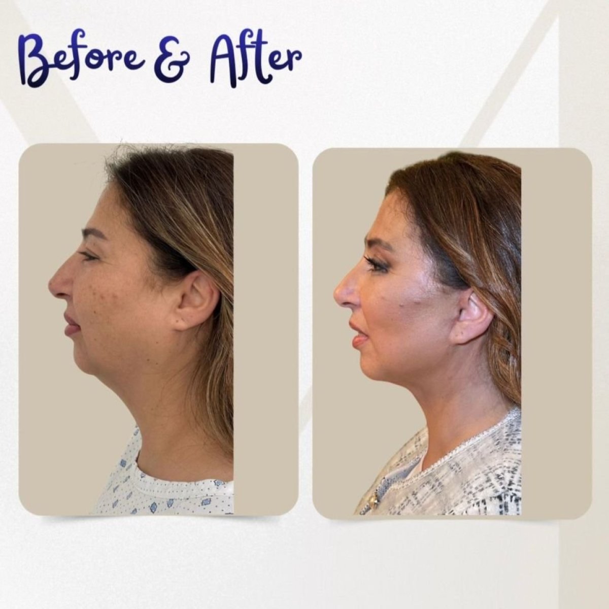 Resultados de lifting de cuello antes y después en Dr. Michel Salameh - Plastic And Aesthetic Surgery